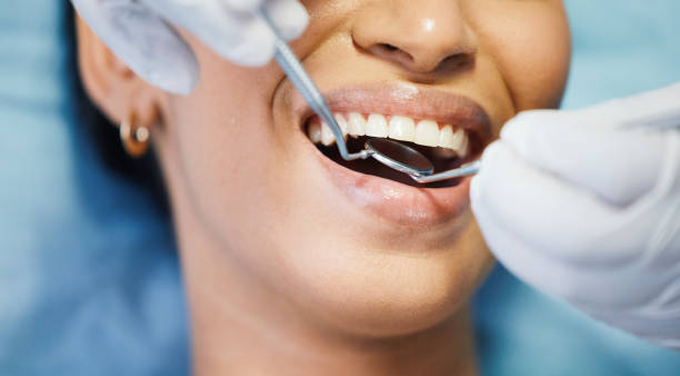 Best Knocked-Out Tooth (Avulsed Tooth) Treatment in Buckeye Lake, OH